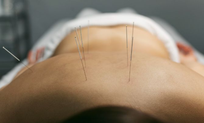 Acupuncture