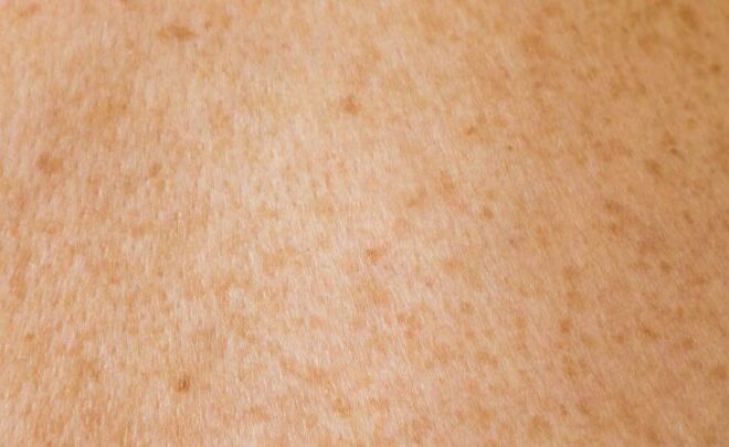 Pigmentation Care Explained: Key Facts You Need to Know