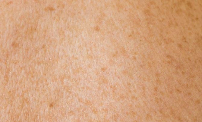 Pigmentation