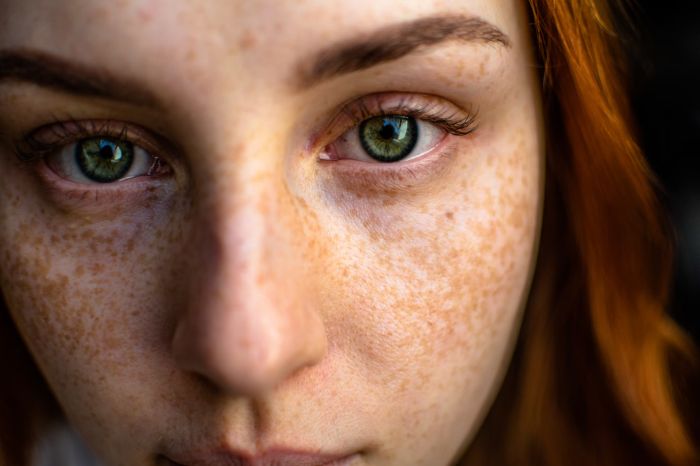 Pigmentation2