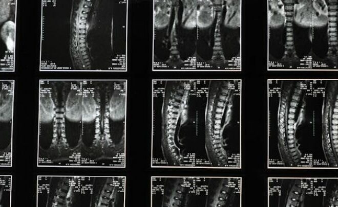 Unseen Battles: The Emotional Impact of Spinal Cord Injuries on Patients and Families