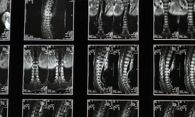 Spinal Cord Injuries