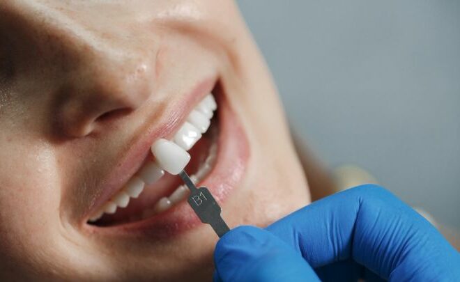 Dental Veneers: Myths, Facts, and What to Expect