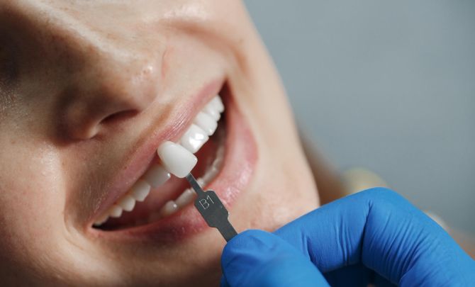Dental Veneers
